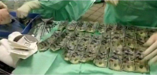 FOTO/ Mjekët zbulojnë një pasuri të vërtetë brenda barkut të gruas