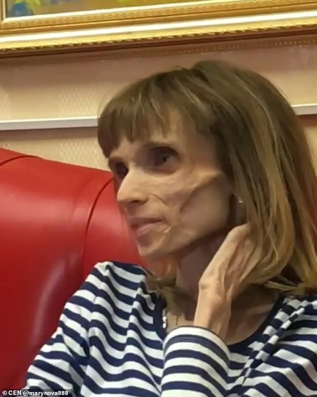 2.7-Stone Anorexic Woman Eats For 1st Time This Year -